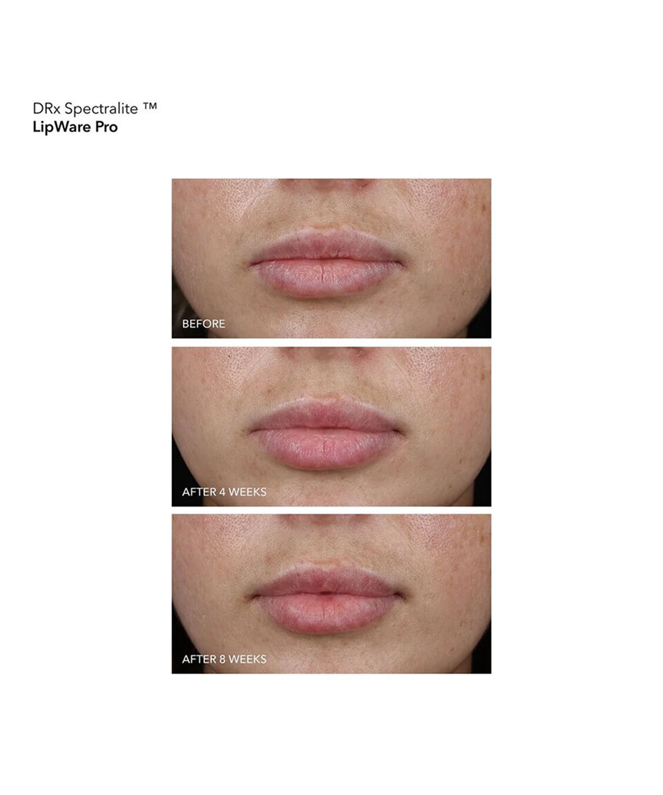 Display Product shot 5 of LipWare Pro LED Device